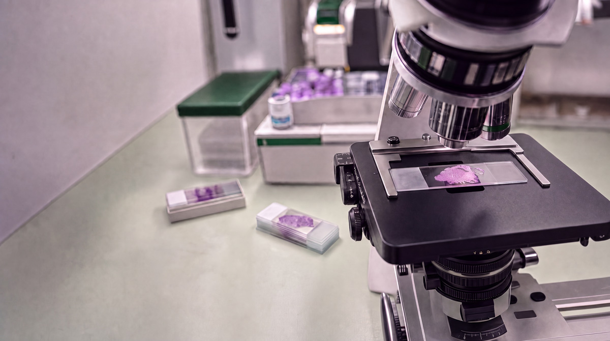 Parece un carcinoma microcítico de libro… hasta que llega lainmunohistoquímica